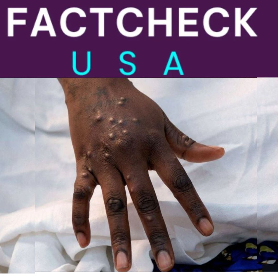 Factcheck: Measles