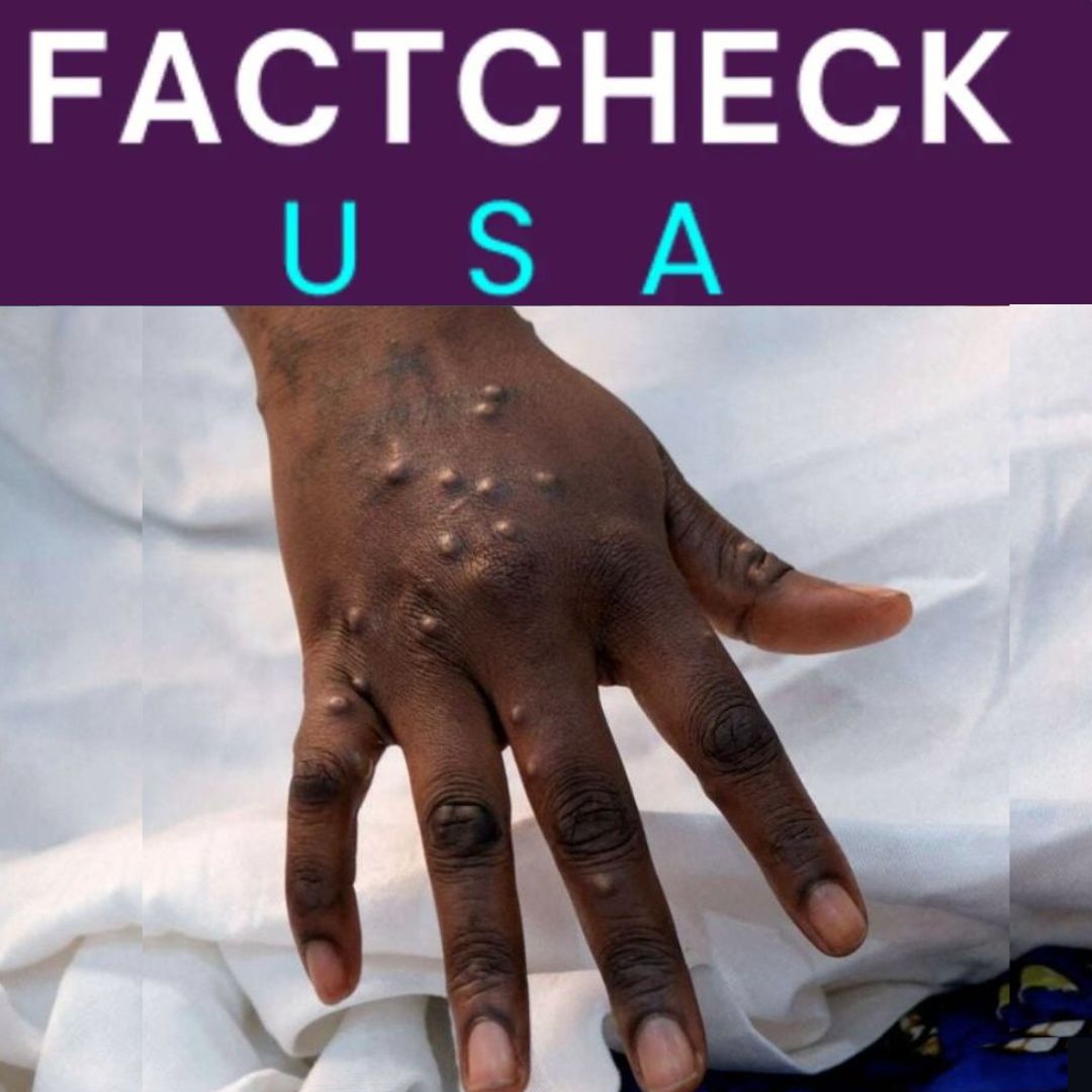 Explainer: Mpox in the U.S. and World